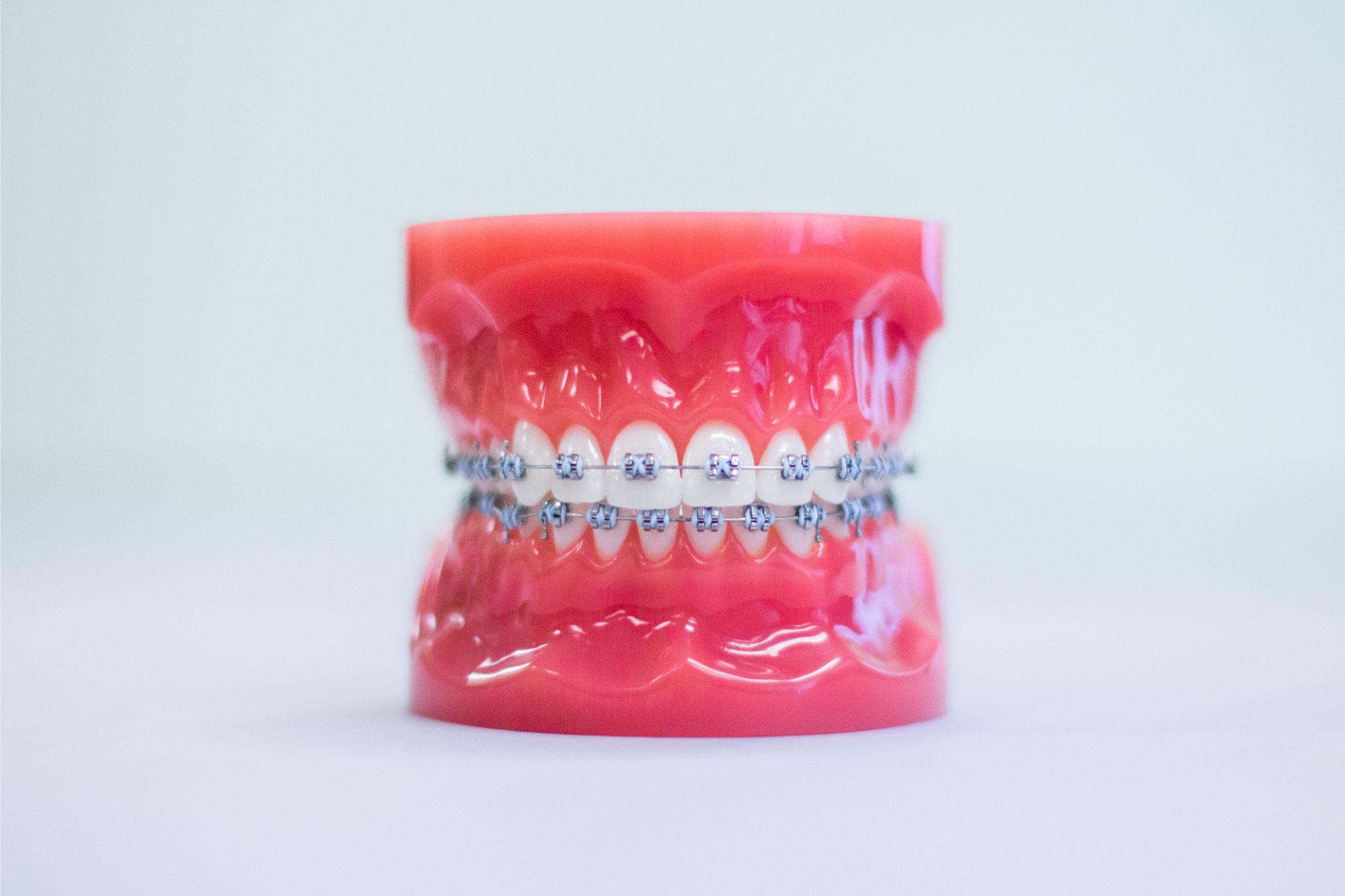 Model of a mouth with metal braces, illustrating orthodontic treatment options for patients at Orthodontic Associates.