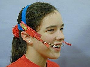Young patient wearing High Pull Headgear appliance, designed for orthodontic treatment to guide facial growth and improve bite alignment.