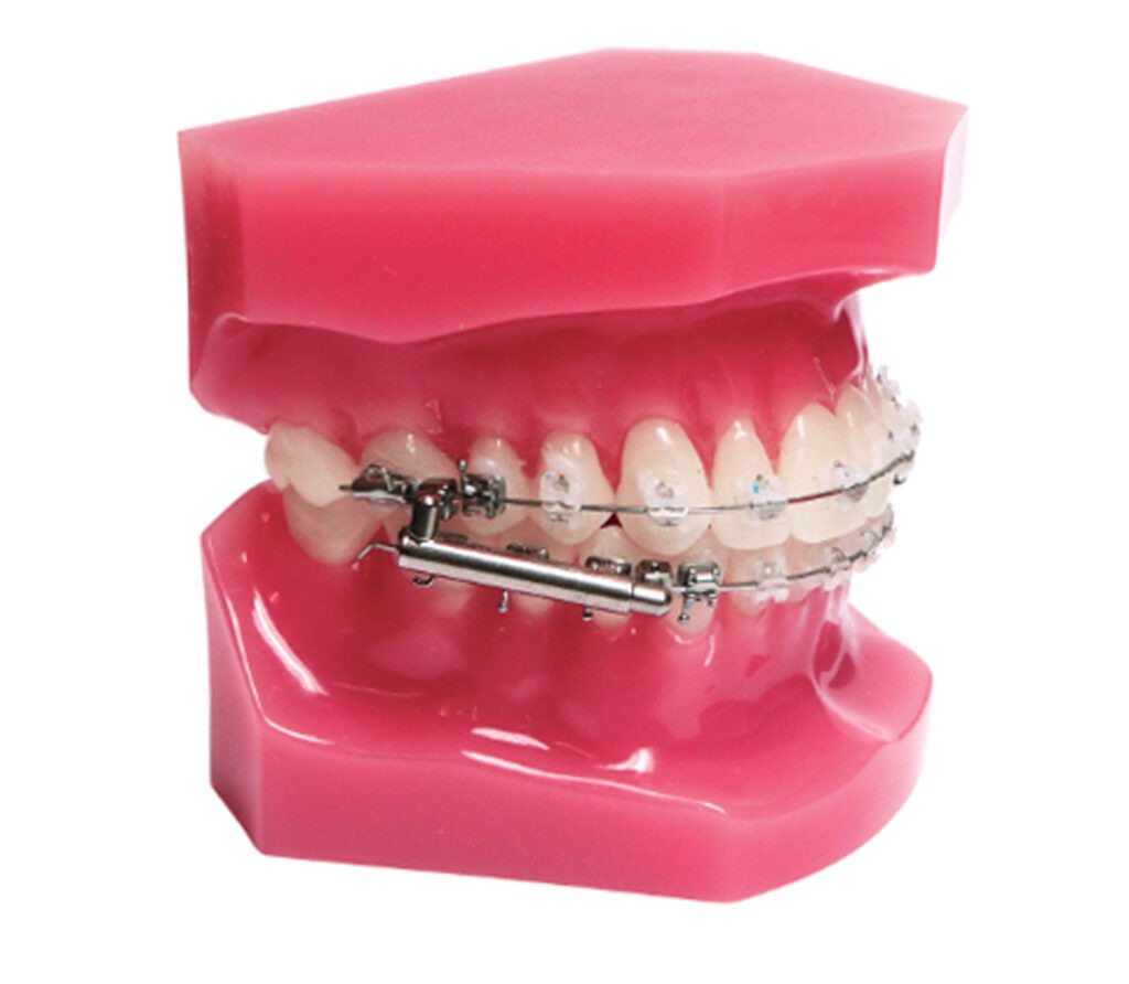 Model of a dental arch with fixed BioBite appliance demonstrating orthodontic treatment for overbite correction.
