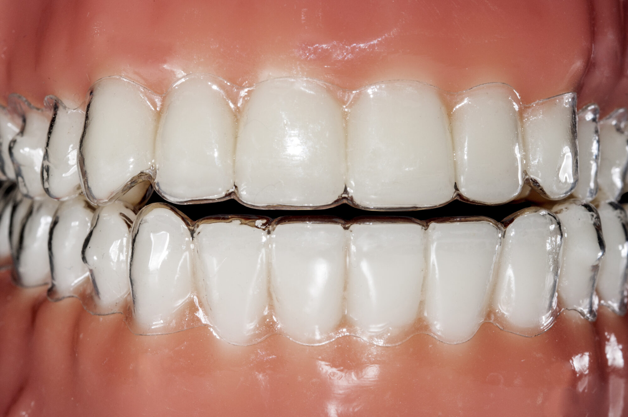 Clear Essix retainer fitted over teeth, illustrating orthodontic appliance for maintaining alignment and support.
